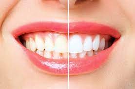 ¿El blanqueamiento dental daña los dientes?