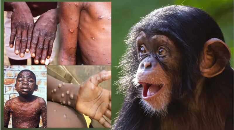 Alerta en Nueva York por paciente con síntomas de la letal Viruela del Mono en hospital de Manhattan