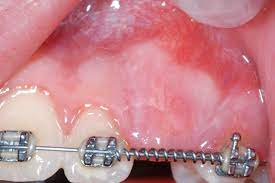 Fenestración dental: ¿qué es y cómo se realiza?