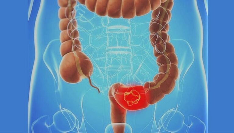 Descifran más de 100 genes relacionados con riesgo cáncer colorrectal 