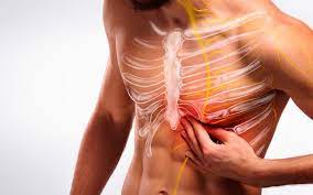 ¿Qué es una distensión muscular intercostal y cómo se trata?