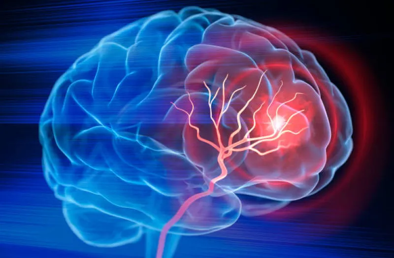 ¿Por qué el derrame cerebral es diferente para las mujeres? Conoce las claves