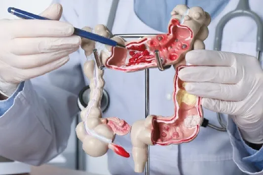 Aumenta en República Dominicana el número de personas que padecen cáncer de colon y recto a temprana edad