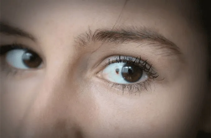 Investigadores crean avatares tumorales que prueban nuevos tratamientos contra el cáncer de ojo