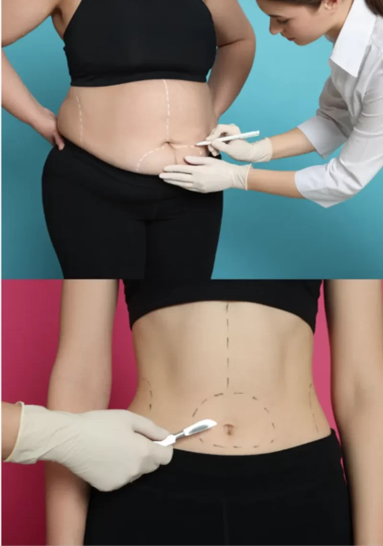 Cirugía estética: ¿puede volver la grasa tras una liposucción?
