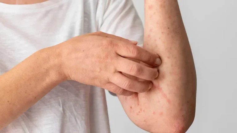 Investigación sugiere que jarabe para la tos puede frenar efectos del Parkinson El ambroxol es un ingrediente que está demostrando eficacia para proteger frente a los síntomas neuropsiquiátricos del Parkinson El hallazgo llega de la mano de una investigación liderada por la Universidad Occidental en Canadá, que reunió en un ensayo clínico a 47 pacientes diagnosticados con demencia por Parkinson. El estudio dividió a los individuos en dos grupos: uno recibió una dosis diaria elevada de ambroxol; el otro, un placebo. Los resultados mostraron que los 22 pacientes que habían sido medicamentos con el fármaco no empeoraron sus síntomas neuropsiquiátricos, frente a los 25 del grupo del placebo que sí sufrieron un deterioro. “Nuestro objetivo era cambiar el curso de la demencia de Parkinson. Este ensayo inicial ofrece esperanza y proporciona una base sólida para estudios más amplios”, declara el neurólogo Stephen Pasternak de la Universidad Occidental. “Estos hallazgos sugieren que el ambroxol puede proteger la función cerebral, especialmente en aquellos con riesgo genético”. Además, los pacientes tratados con ambroxol sufrieron menos caídas y mantuvieron estables síntomas como delirios, alucinaciones, ansiedad, irritabilidad, apatía y alteraciones motoras. Te puede interesar leer: Enfermedad de Parkinson: FDA aprueba dispositivo que anticipa los síntomas con inteligencia artificial Una mejora cognitiva Ambos grupos presentaron resultados similares en pruebas cognitivas relacionadas con memoria y lenguaje, y no se observaron mejoras clínicas significativas en la cognición general. Sin embargo, el equipo investigador identificó que algunos participantes portadores del gen GBA1 de alto riesgo para Parkinson mostraron mejoría cognitiva bajo tratamiento con ambroxol. Los autores advierten que, debido al tamaño reducido de la muestra y la ausencia de un grupo control específico para este subgrupo, estos resultados deben interpretarse con cautela y requieren estudios adicionales. El gen GBA1, cuando presenta variantes de alto riesgo, suele asociarse a una menor actividad de la enzima glucocerebrosidasa (GCase), lo que favorece la acumulación de proteínas en el cerebro, como los cuerpos de Lewy, característicos de la demencia por Parkinson. Otras investigaciones recientes ya habían demostrado que ambroxol puede incrementar de forma significativa la actividad de GCase. En el ensayo actual, los pacientes tratados con el fármaco alcanzaron 1,5 veces más actividad enzimática que el grupo placebo. En cuanto a la seguridad, no se reportaron efectos adversos graves entre quienes recibieron ambroxol, aunque sí se documentaron molestias gastrointestinales leves o moderadas que llevaron a algunos participantes a abandonar el estudio. La capacidad de ambroxol para atravesar la barrera hematoencefálica ha llevado a algunos científicos a plantear su potencial para tratar no solo el Parkinson, sino también otras enfermedades neurodegenerativas como la esclerosis lateral amiotrófica (ELA), la enfermedad de Gaucher, la neuroinflamación o lesiones medulares. No obstante, los autores subrayan que confirmar esta hipótesis requerirá más ensayos clínicos. El reciente avance en la demencia por Parkinson, según Pasternak, “ofrece esperanza y una base sólida para estudios de mayor envergadura”. Fuente: Infobae