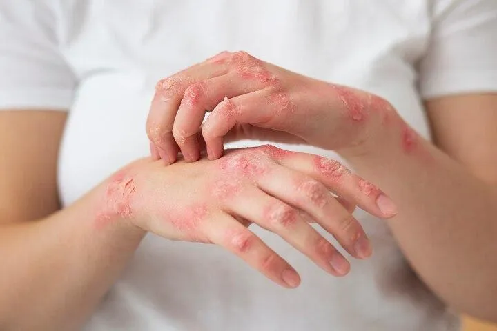 Dermatóloga Laura Sánchez asegura la lepra se cura y tiene tratamiento gratuito en República Dominicana
