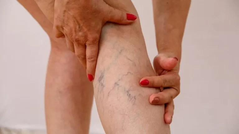Médicos descartan remedios naturales para eliminar las varices