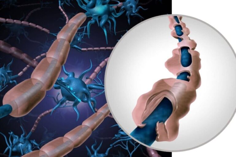 Esclerosis múltiple es una enfermedad sin cura con varios tratamientos