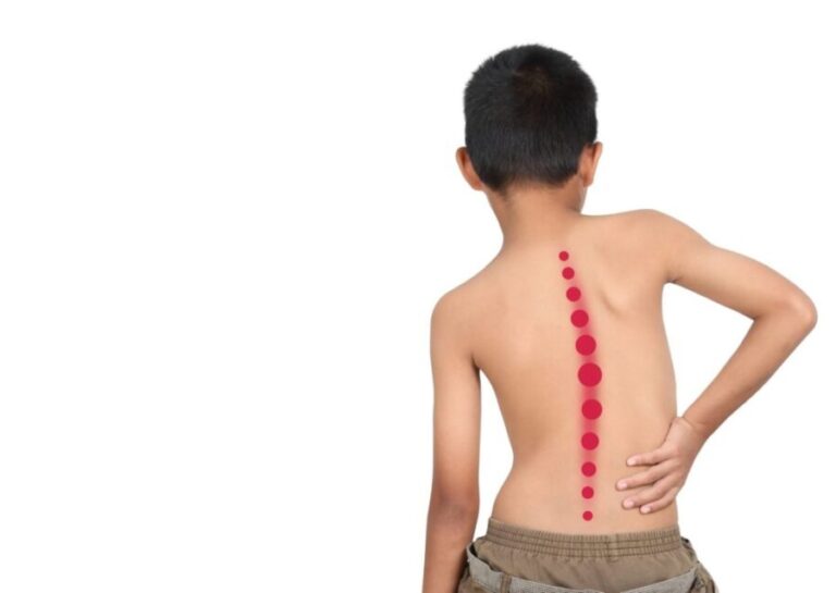 ¿Cómo puede un padre detectar una escoliosis a tiempo?
