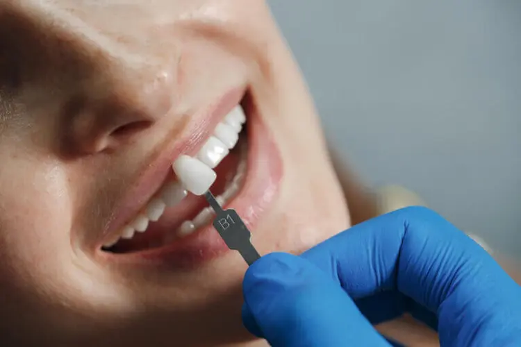 Carillas dentales: lo que conviene saber antes de mejorar tu sonrisa
