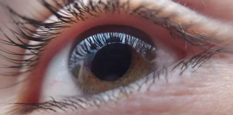 Retinosis pigmentaria en RD: Las señales en la visión que no deberían pasarse por alto